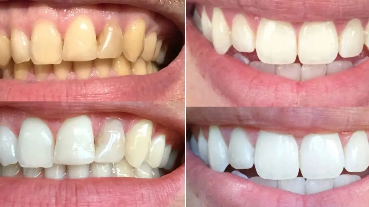 Man's, 68, teeth 'yellowed significantly' now 'noticeably whiter' with €2