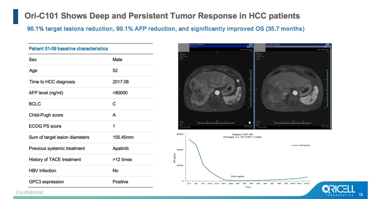 ASCO 2026 | Oricell's GPC3 CAR-T Ori-C101 Hits 66.7% ORR in Late-Line HCC, Signaling Best-in-Class Potential